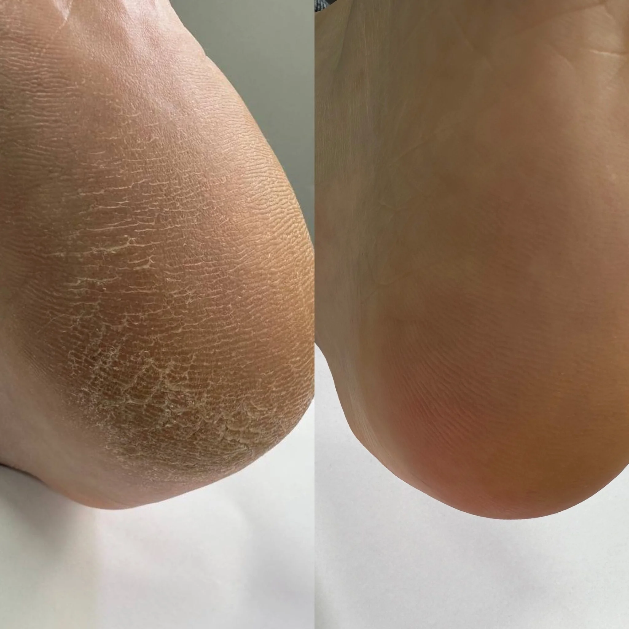 NAILSOFTHEDAY Keratolytic – Keratolytikum für die Füße, mit 20 % Urea, 100 ml – Bild 6