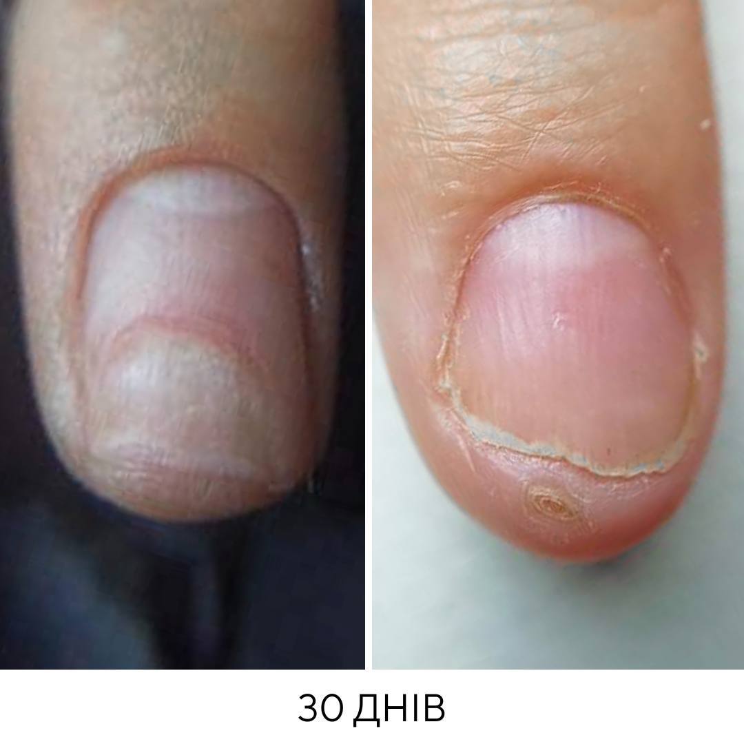 NAILSOFTHEDAY ONISTOP – regenerierendes Öl gegen Onycholyse, 15 ml – Bild 8