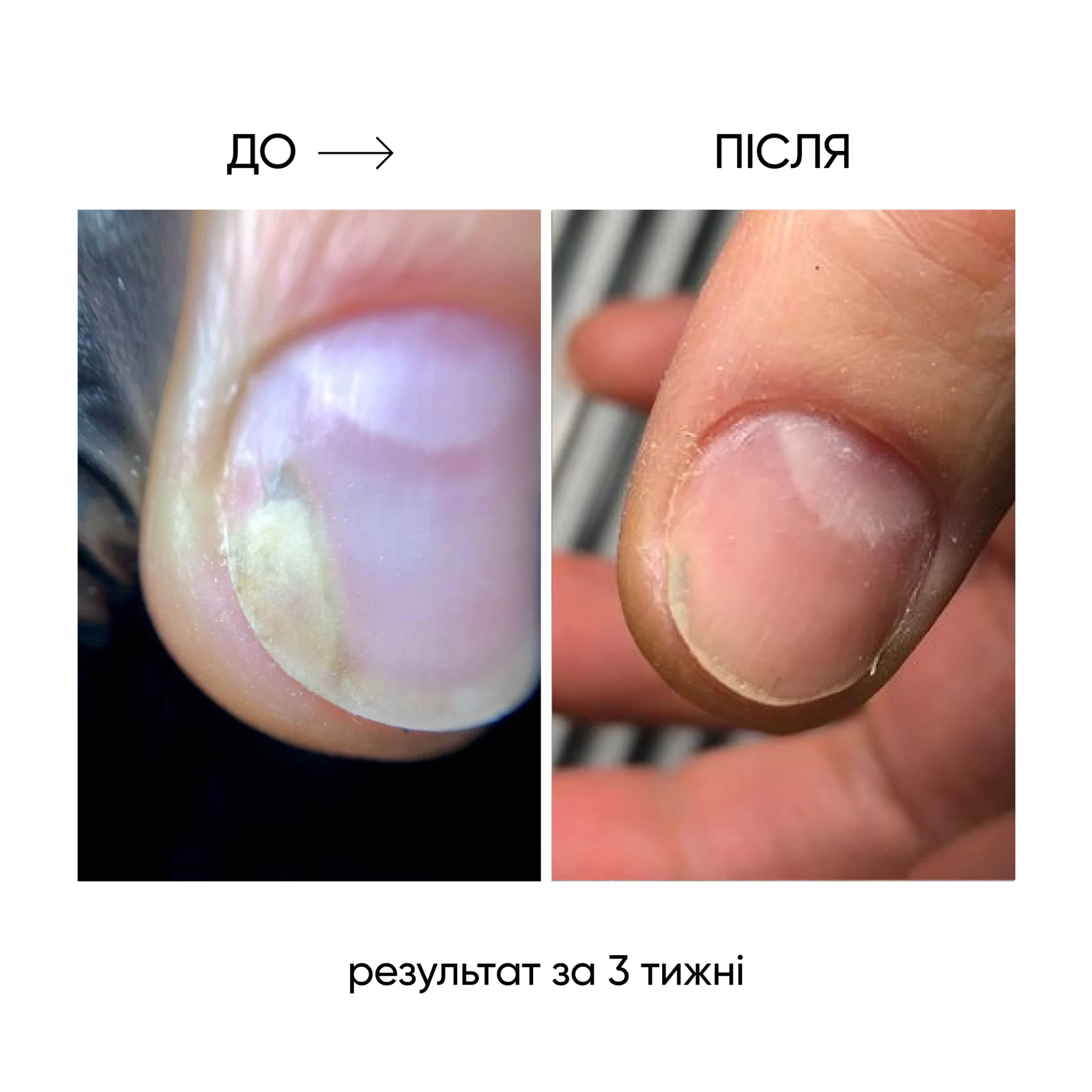 NAILSOFTHEDAY ONISTOP – regenerierendes Öl gegen Onycholyse, 15 ml – Bild 13